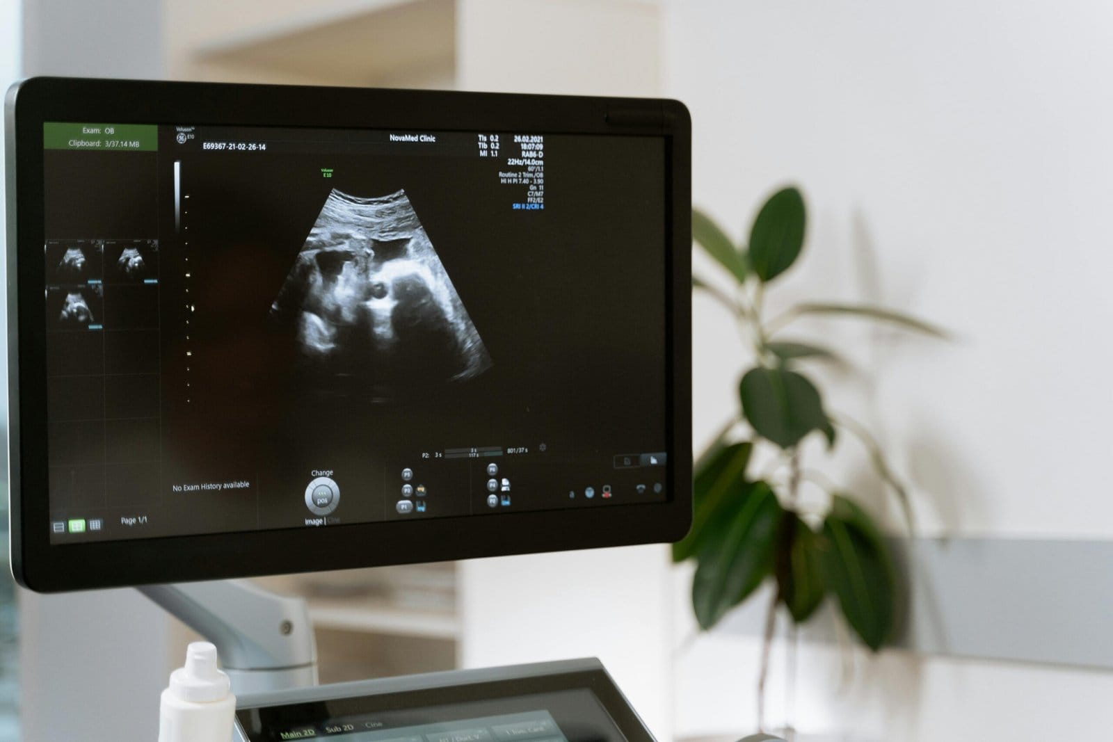 Ultrasound monitor at the bedside